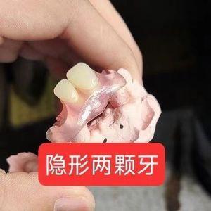 定制缺牙牙套隐形义齿门牙仿真假牙钢托镶牙种植临时牙补牙定做